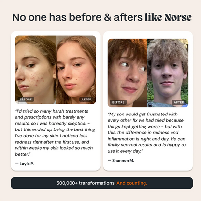 The Complete Acne Killer System 2.0